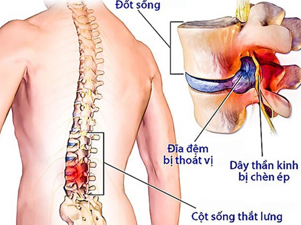 Chưa thoát vị đĩa đệm, thoái hóa cột sống theo khi công y đạo