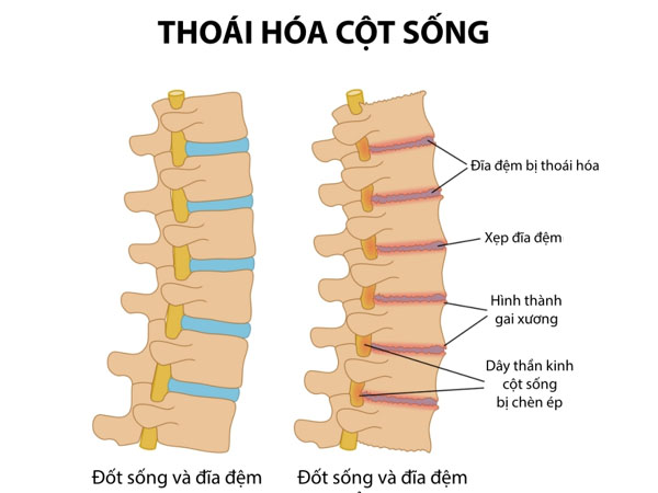 Video hướng dẫn phương thức ăn uống và các bài tập của bệnh thoái hóa cột sống của thầy Vương Văn Liêu